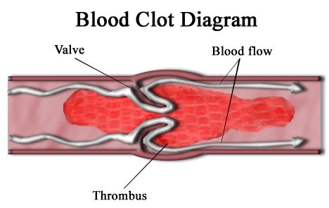 Thrombosis Thrombocytopenia Syndrome (TTS)